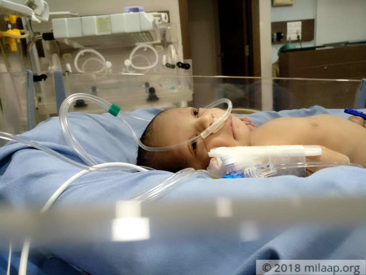 This 4DayOld Baby Will Suffocate To Death Unless He Gets A Milaap